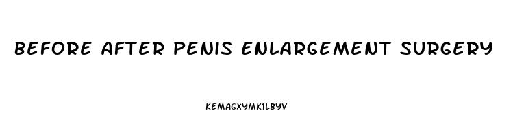 Before After Penis Enlargement Surgery