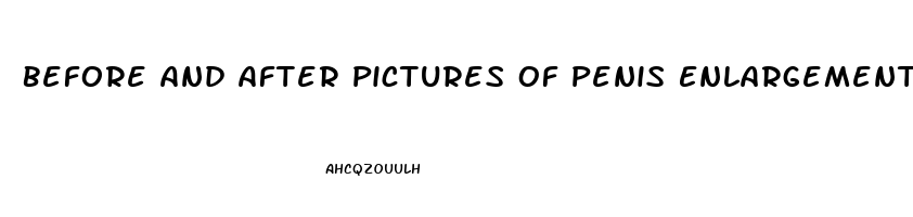 Before And After Pictures Of Penis Enlargement