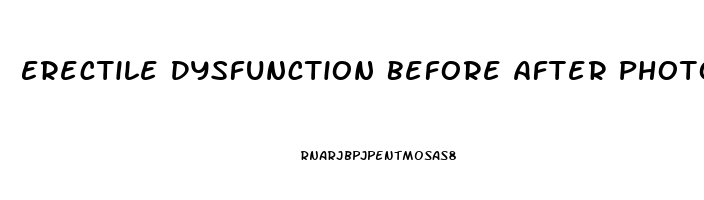 Erectile Dysfunction Before After Photos