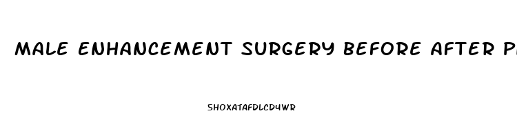 Male Enhancement Surgery Before After Pictures