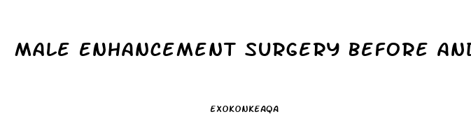 Male Enhancement Surgery Before And After