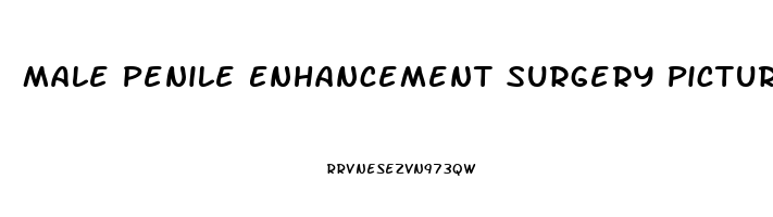 Male Penile Enhancement Surgery Pictures