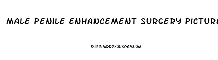 Male Penile Enhancement Surgery Pictures