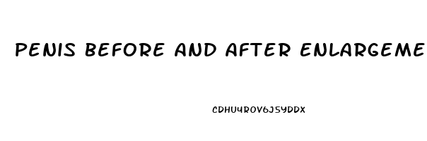 Penis Before And After Enlargement