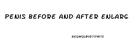 Penis Before And After Enlargement