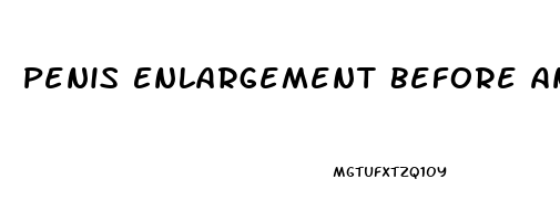 Penis Enlargement Before And After Surgery