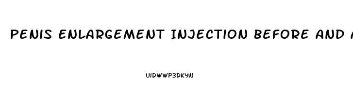 Penis Enlargement Injection Before And After