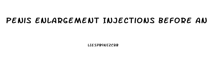 Penis Enlargement Injections Before And After