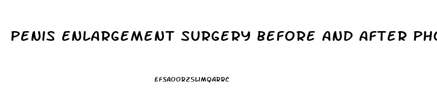 Penis Enlargement Surgery Before And After Photos