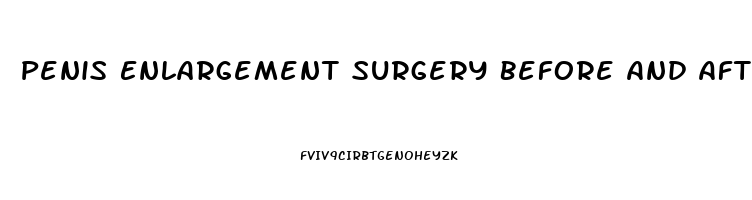 Penis Enlargement Surgery Before And After Photos