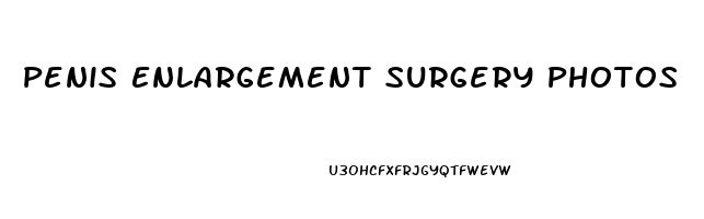 Penis Enlargement Surgery Photos