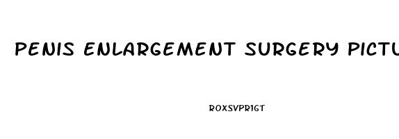 Penis Enlargement Surgery Pictures