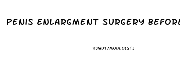 Penis Enlargment Surgery Before And After