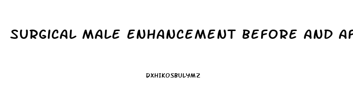 Surgical Male Enhancement Before And After