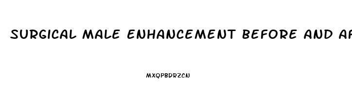 Surgical Male Enhancement Before And After