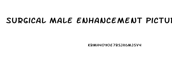 Surgical Male Enhancement Pictures