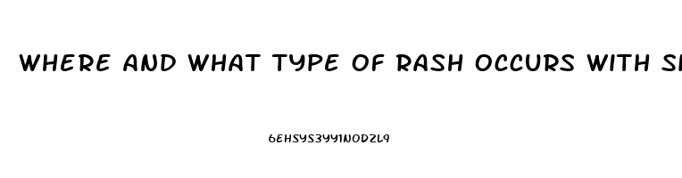 Where And What Type Of Rash Occurs With Sildenafil