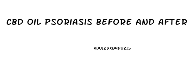 Cbd Oil Psoriasis Before And After