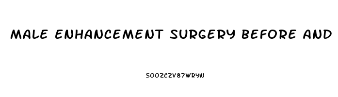 Male Enhancement Surgery Before And After