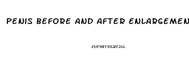 Penis Before And After Enlargement