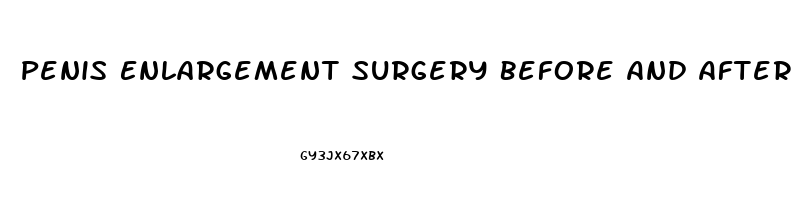 Penis Enlargement Surgery Before And After Erect