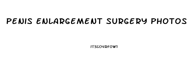 Penis Enlargement Surgery Photos