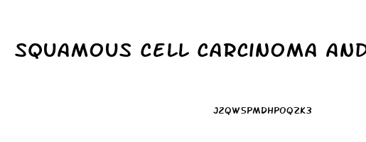 Squamous Cell Carcinoma And Cbd Oil