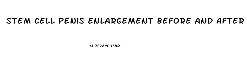 Stem Cell Penis Enlargement Before And After