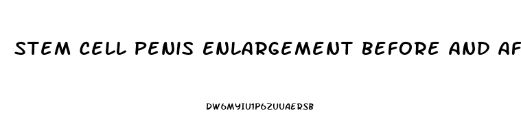 Stem Cell Penis Enlargement Before And After