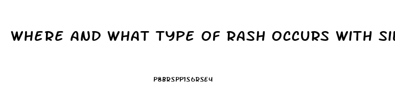 Where And What Type Of Rash Occurs With Sildenafil