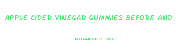 apple cider vinegar gummies before and after