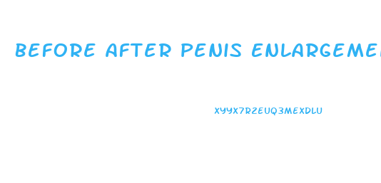 Before After Penis Enlargement Pic