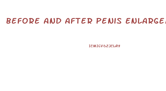 Before And After Penis Enlargement Photos