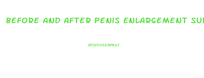 Before And After Penis Enlargement Surdry