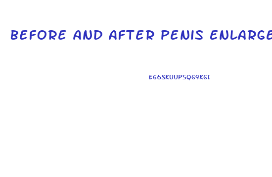 Before And After Penis Enlargement Surgery