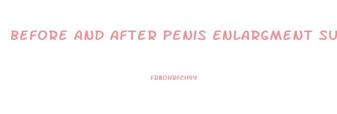 Before And After Penis Enlargment Surgery