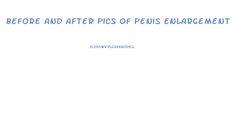 Before And After Pics Of Penis Enlargement