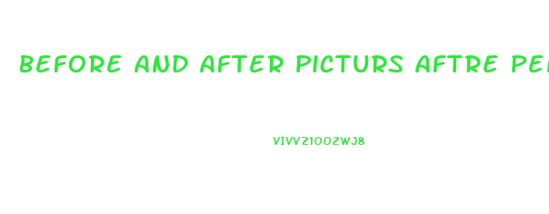 Before And After Picturs Aftre Penis Enlargement