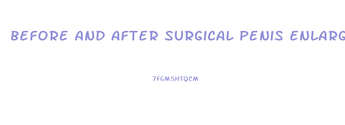 Before And After Surgical Penis Enlargement