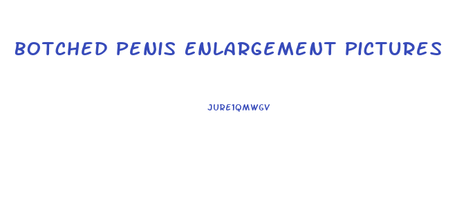 Botched Penis Enlargement Pictures
