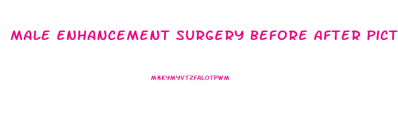 Male Enhancement Surgery Before After Pictures