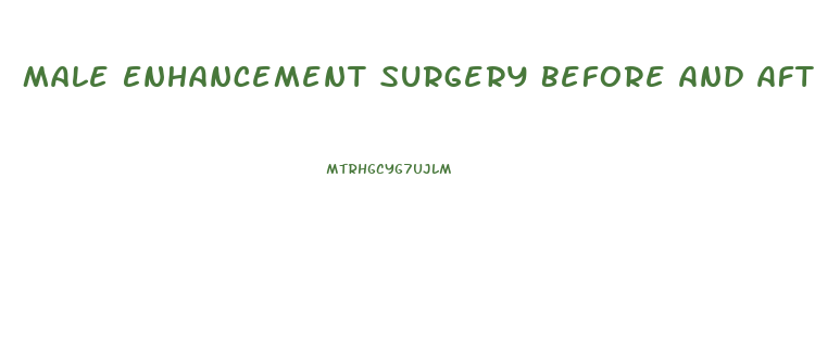 Male Enhancement Surgery Before And After Photos