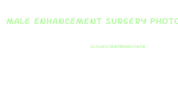 Male Enhancement Surgery Photos