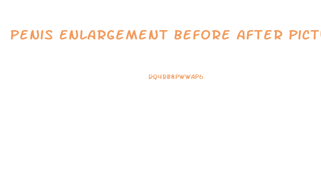 Penis Enlargement Before After Pictures