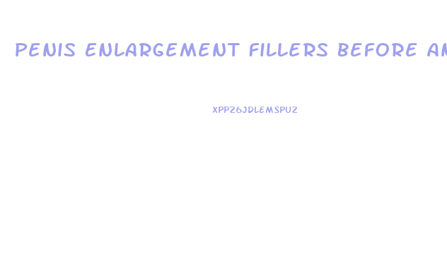 Penis Enlargement Fillers Before And After