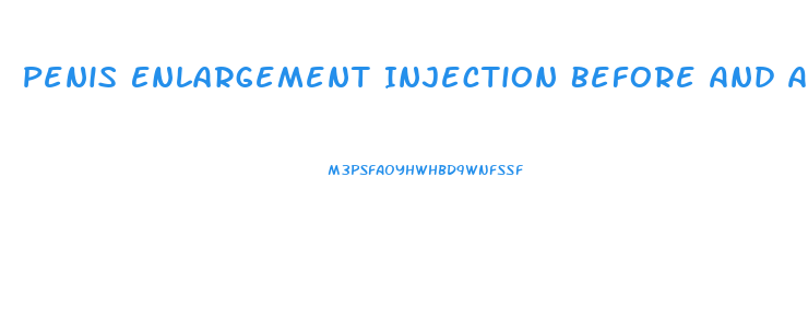 Penis Enlargement Injection Before And After