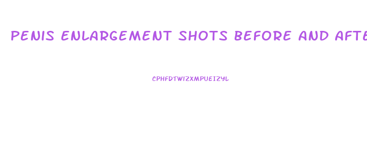 Penis Enlargement Shots Before And After