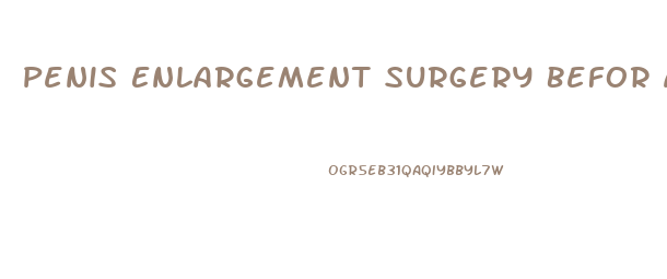 Penis Enlargement Surgery Befor After