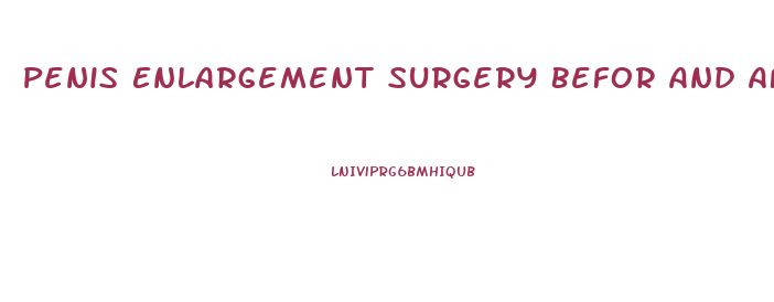 Penis Enlargement Surgery Befor And After