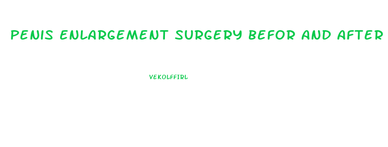 Penis Enlargement Surgery Befor And After